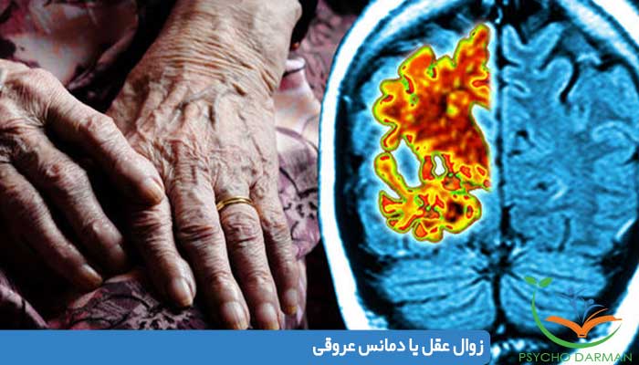 زوال عقل یا دمانس عروقی